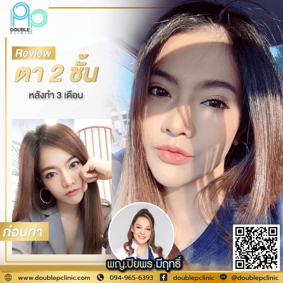 ทำตาสองชั้นเติมไขมันใต้ตา