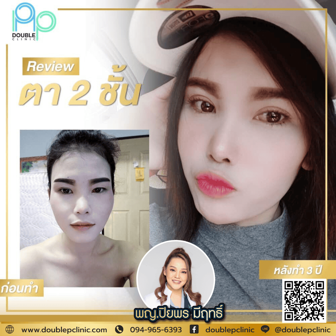ทำตาสองชั้น แผลสั้น