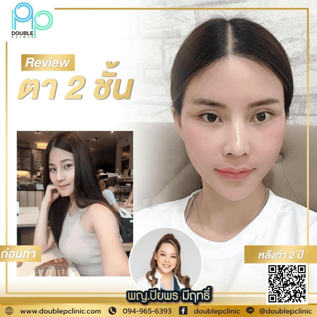 ทำตาสองชั้น แผลสั้น