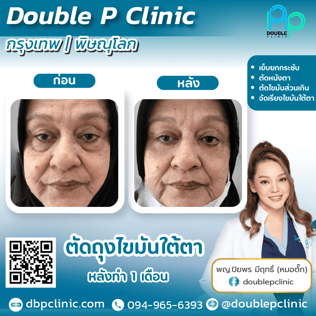 การผ่าตัดถุงใต้ตา เหมาะกับใคร