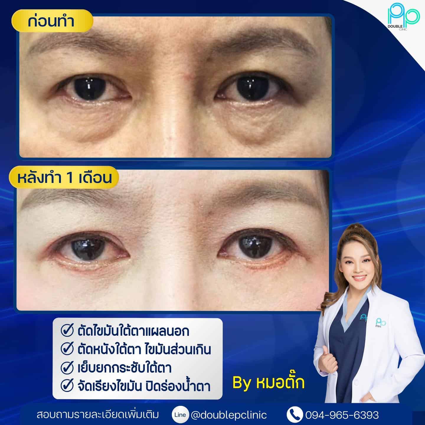 ร่องน้ำตาลึก Deep Tear Troughs