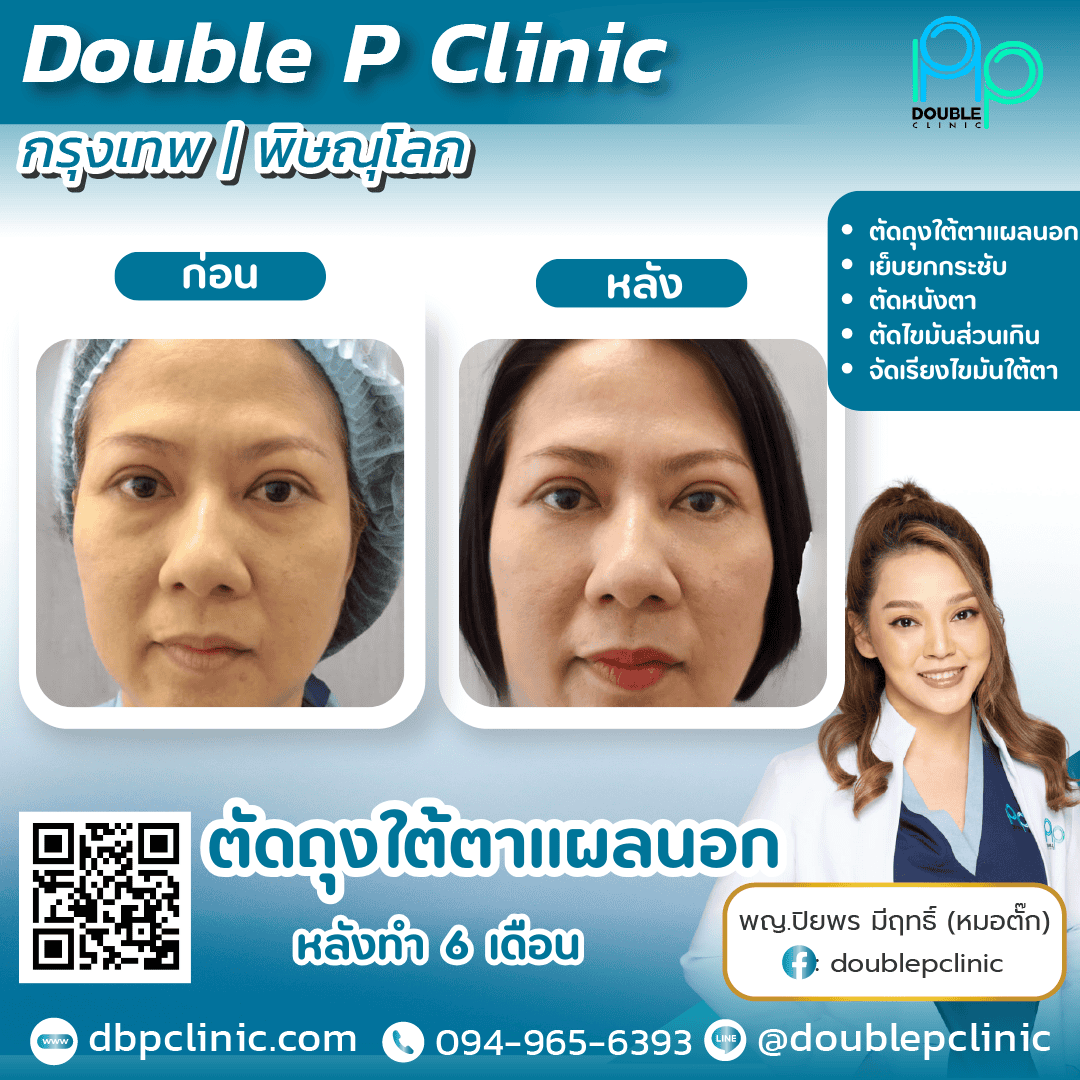 ตัดถุงใต้ตาเหมาะกับใคร ตัดถุงใต้ตาเหมาะกับใคร