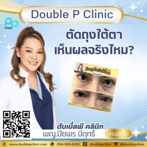 ตัดถุงใต้ตา เห็นผลจริงไหม?