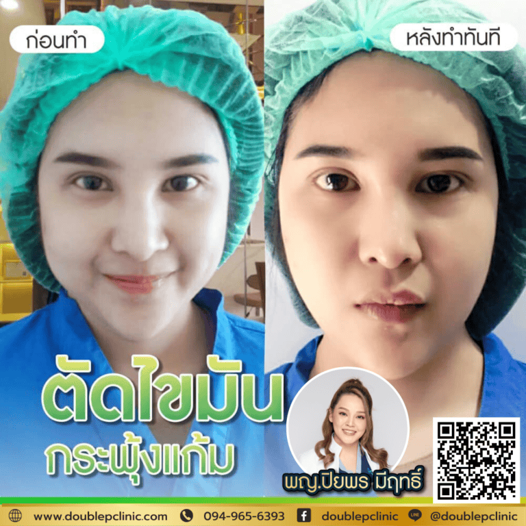 รีวิว ตัดไขมันกระพุ้งแก้ม หมอตั๊ก?