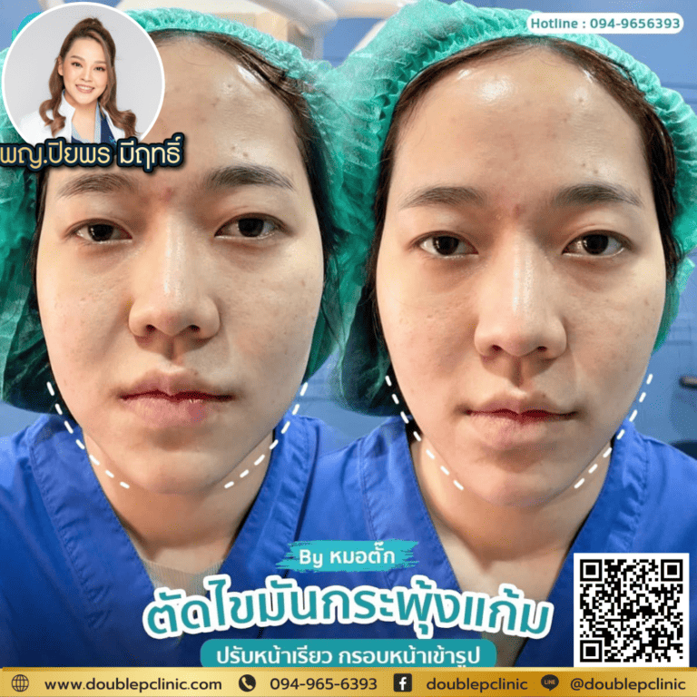 ตัดไขมันกระพุ้งแก้ม Double P Clinic ราคา?