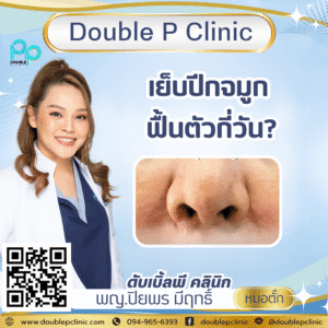 เย็บปีกจมูก ฟื้นตัวกี่วัน?