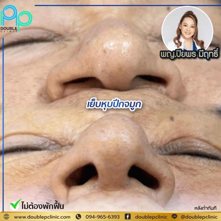 เย็บปีกจมูก มีผลข้างเคียงอะไรบ้าง?
