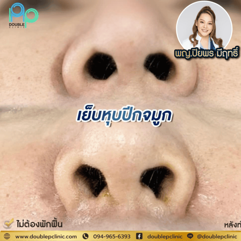 เย็บปีกจมูก เจ็บไหม? 