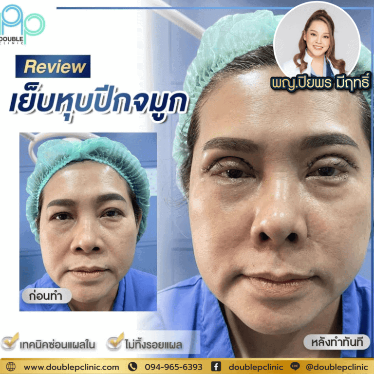 เย็บปีกจมูก หายใจไม่ออกจริงหรือ ?