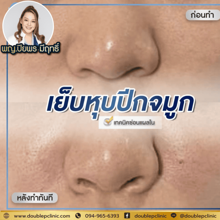 ทำไมต้องไม่ควรตัดปีกจมูก? 