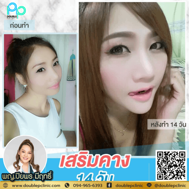 เสริมคางอยู่ได้กี่ปี?