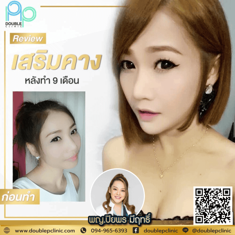 คางบุ๋ม เสริมคางแผลใน ช่วยได้ไหม?