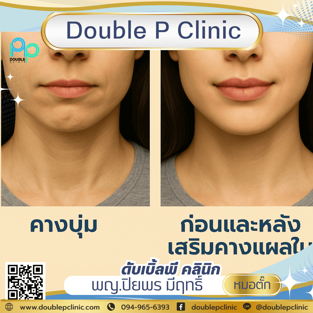 คางบุ๋ม เสริมคางแผลใน ช่วยได้ไหม?