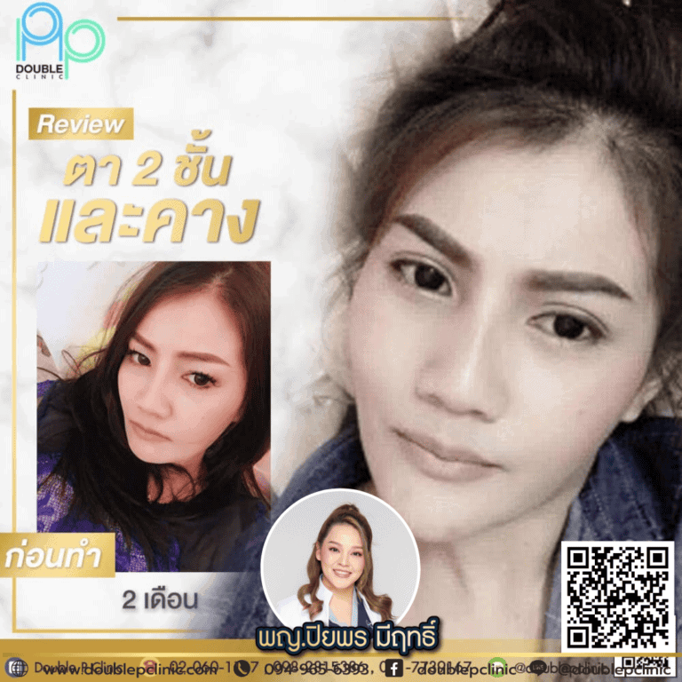 ทำคางแล้วหน้าเปลี่ยนไหม?